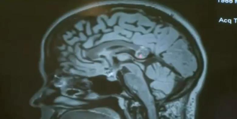 Caz șocant: Embrion uman, descoperit în creierul unei femei! (VIDEO)