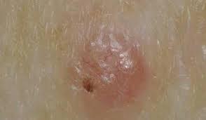 Uniunea Europeană a dat undă verde unui nou tratament contra melanomului