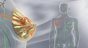 CANCER DE SÂN. Teste care spun Da sau Nu chimioterapiei