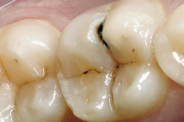 Pasta de dinți previne apariția cariilor. Adevărat sau fals?