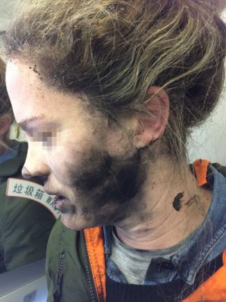 Pasagera unui avion a fost arsă pe faţă şi mâini în urma exploziei căştilor sale audio pe baterii