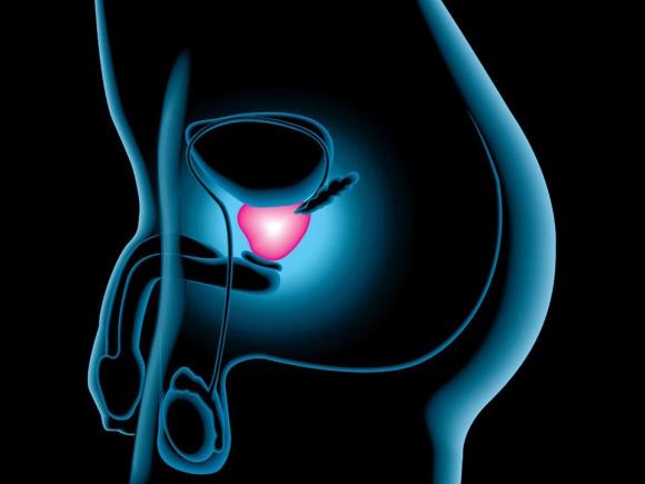 Cancerul de prostată: Un nou tratament care asigură vindecarea, fără efecte secundare 