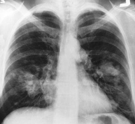 Terapia care blochează cancerul pulmonar agresiv