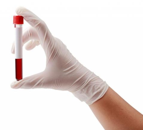 Cancer de vezică: Testul de sânge pentru estimarea evoluţiei tumorii şi a riscului de recidivă 