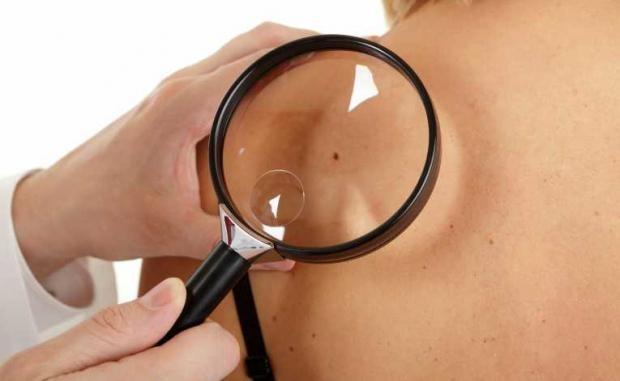 Două terapii combinate pot stopa evoluția melanomului