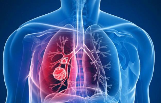 Cancerul pulmonar: Aviz favorabil pentru un nou medicament, în Uniunea Europeană 