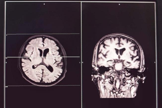 A fost descoperit un nou tip de demenţă, care mimează maladia Alzheimer