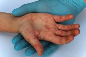 Primul caz de variola maimuței depistat în România