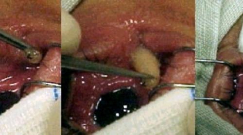 Medicii de la Lima au scos un vierme imens din ochiul unui băiat de 16 ani cu ajutorul... frunzelor de busuioc 