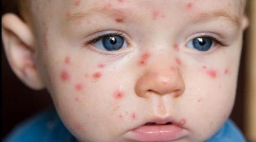 Epidemie de rujeolă în România. Ministerul Sănătăţii condamnă campania contra vaccinării copiilor