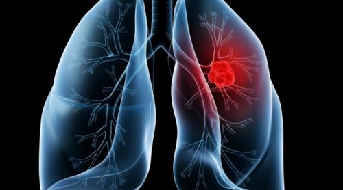 Ibuprofenul reduce riscul de cancer pulmonar?!