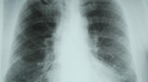 Fibroza pulmonară idiopatică, o boală versatilă și misterioasă 