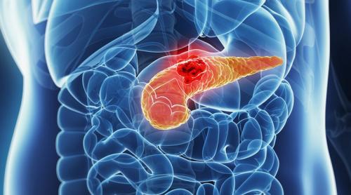Cancerul pancreatic: Un tratament dătător de speranță