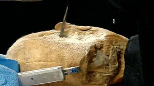 Neurochirurgie: Robotul care forează craniul în mai puțin de trei minute 