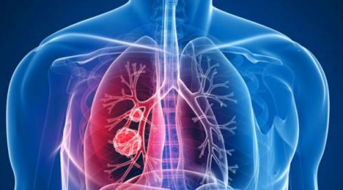 Cancerul pulmonar: Aviz favorabil pentru un nou medicament, în Uniunea Europeană 