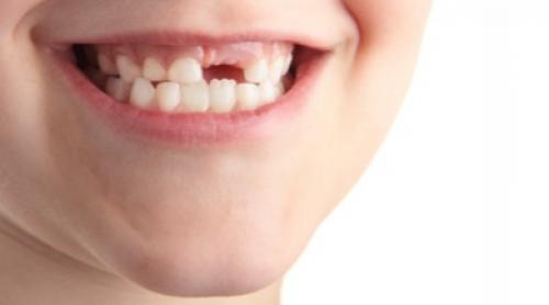 Dinții de lapte: Nu-i aruncați, deoarece conțin celule sușe utile în lupta contra multor boli!