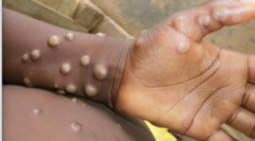 Un caz de variolă a maimuței a fost confirmat în Anglia, spune Agenția de Securitate a Sănătății din Marea Britanie