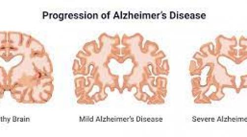 Descoperire medicală revoluționară: un simplu test de sânge va detecta boala Alzheimer